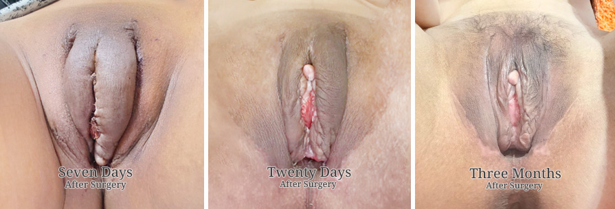 Gender Reassignment / SRS 11 SRS Skin Graft01