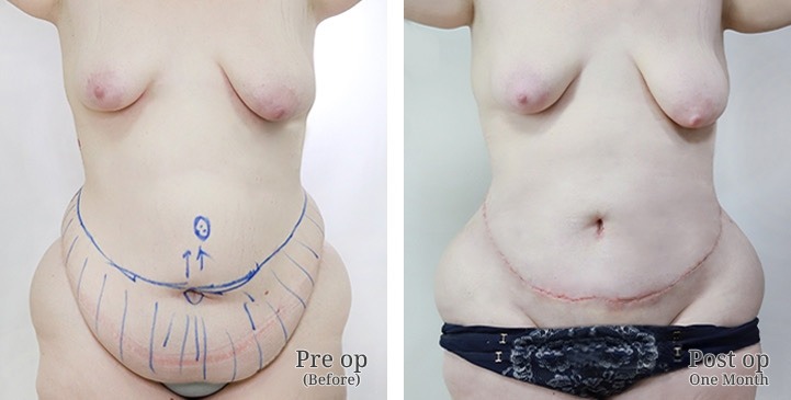 Abdominoplasty / Tummy Tuck / Abdominal Plastic Surgery in Bangkok, Thailand 6 WhatsApp Image 2026 10 05 at 13.56.39 (4)