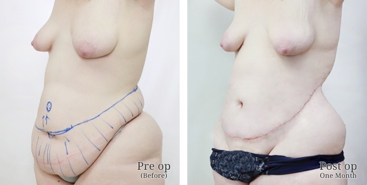 Abdominoplasty / Tummy Tuck / Abdominal Plastic Surgery in Bangkok, Thailand 4 WhatsApp Image 2026 10 05 at 13.56.39 (6)