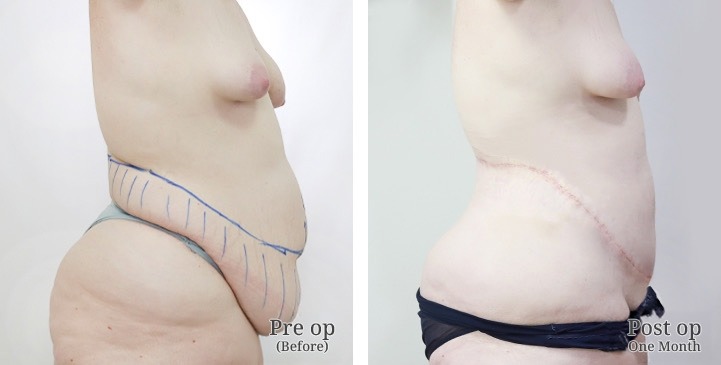 Abdominoplasty / Tummy Tuck / Abdominal Plastic Surgery in Bangkok, Thailand 3 WhatsApp Image 2026 10 05 at 13.56.40 (1)