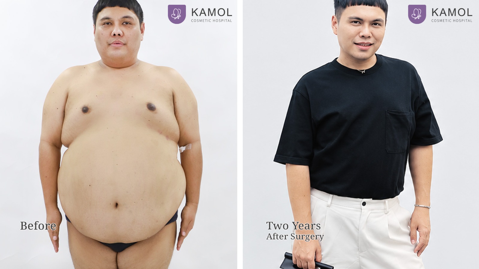 Bariatric / Metabolic / Weight Loss Surgery in Bangkok, Thailand 3 WhatsApp Image 2026 10 06 at 18.18.53 (1)