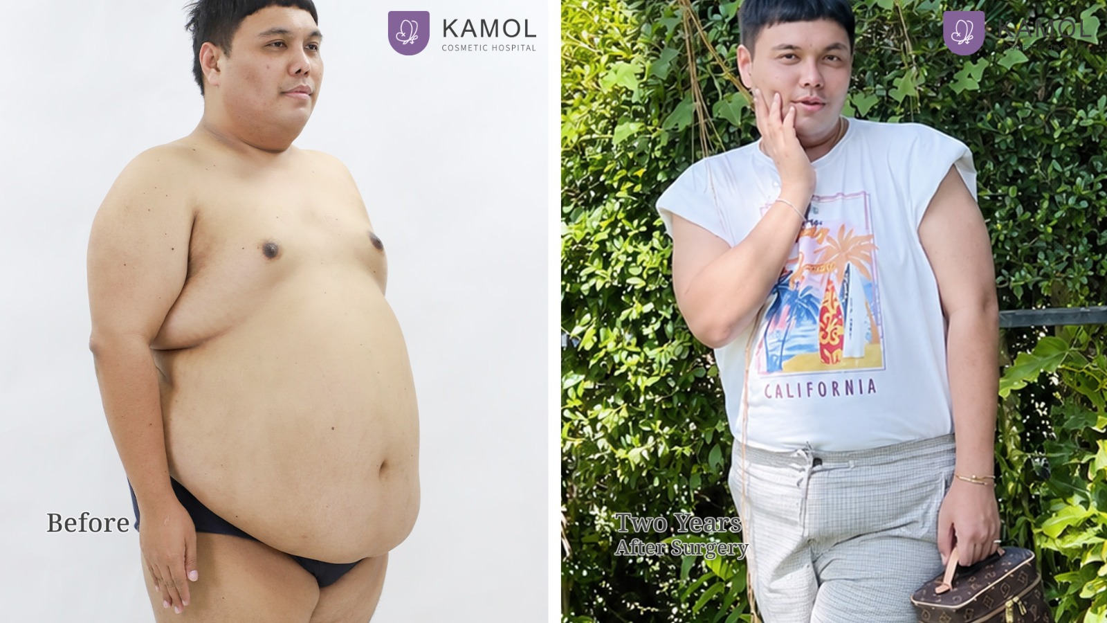 Bariatric / Metabolic / Weight Loss Surgery in Bangkok, Thailand 2 WhatsApp Image 2026 10 06 at 18.18.54