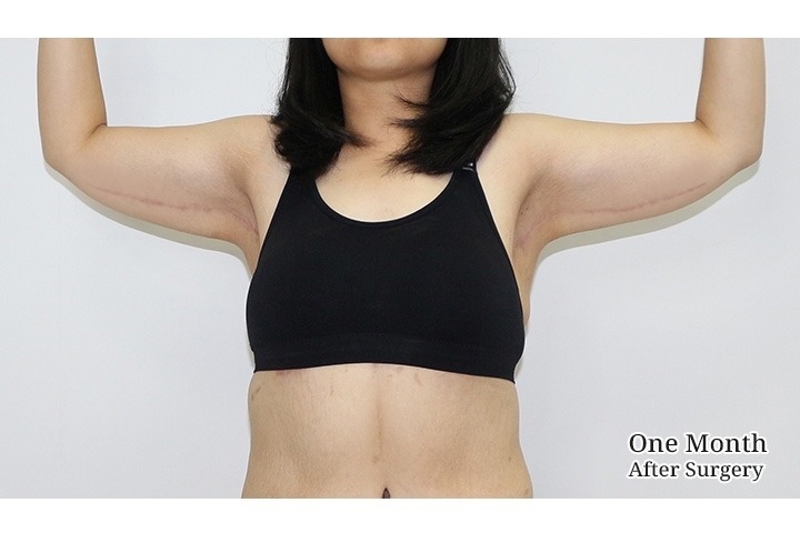 Upper Arm Lift Surgery / Brachioplasty in Bangkok, Thailand 5 WhatsApp Image 2026 10 09 at 11.35.14
