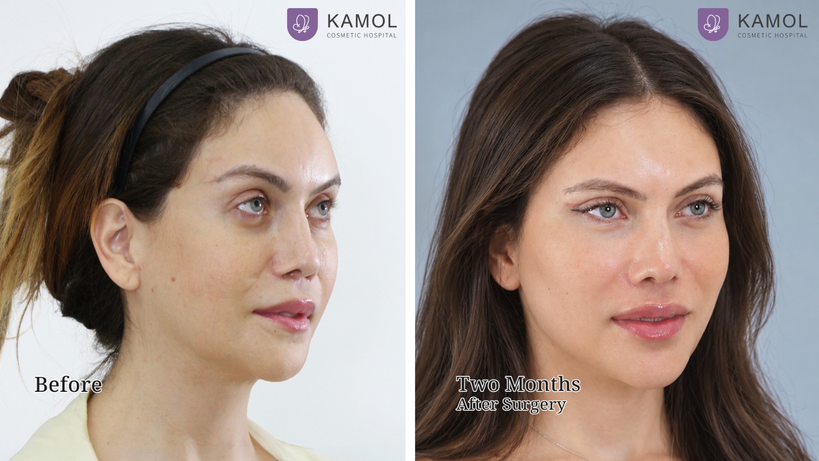 Face Lift 34 Mid Facelift with Deep Plane Technique