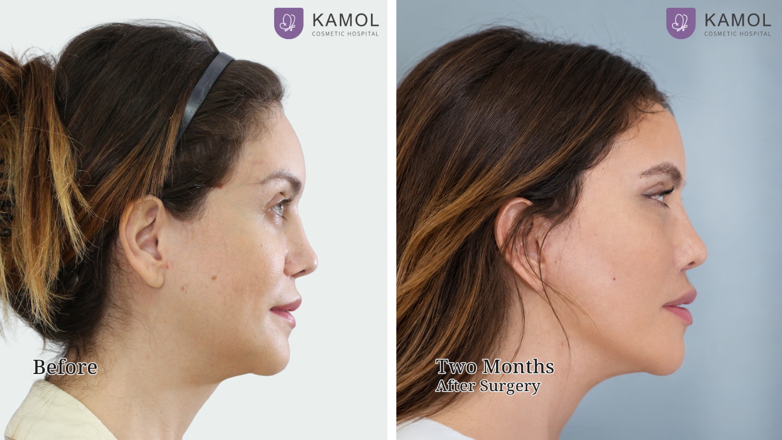 Face Lift 35 Mid Facelift with Deep Plane Technique