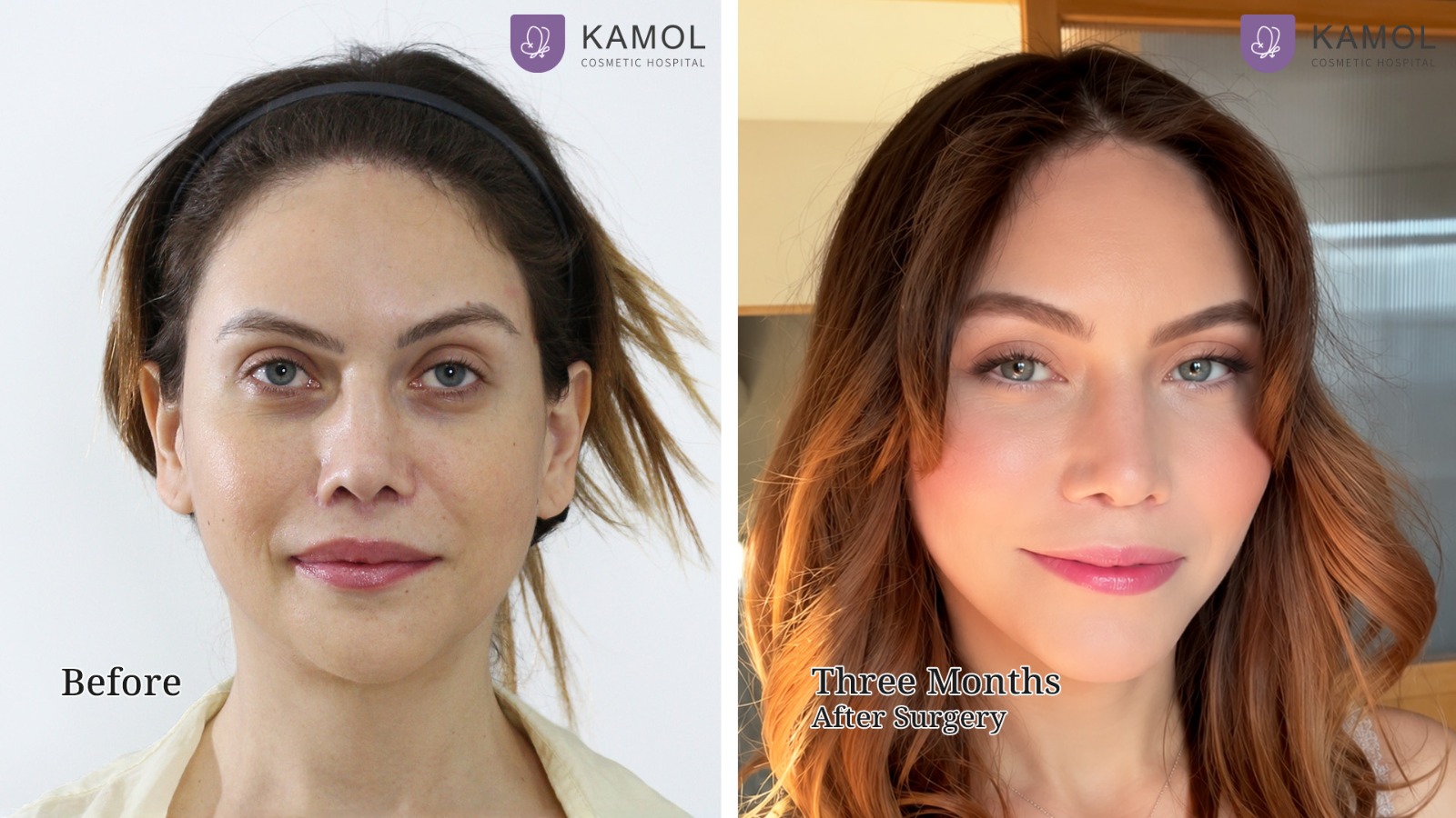 Face Lift 33 Mid Facelift with Deep Plane Technique